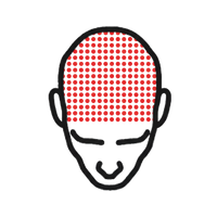 צפיפות מירבית לזקיקי השערה